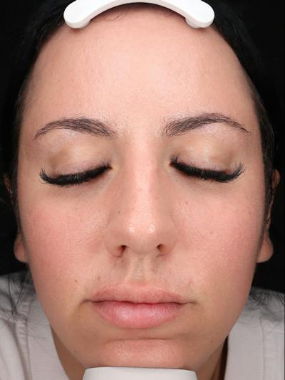 Skin Care Protocol Before & After Gallery - Patient 145945 - Image 2