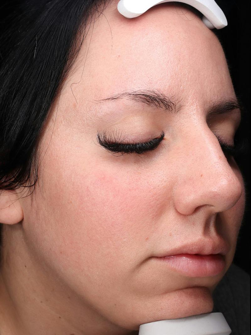 Skin Care Protocol Before & After Gallery - Patient 145945 - Image 3