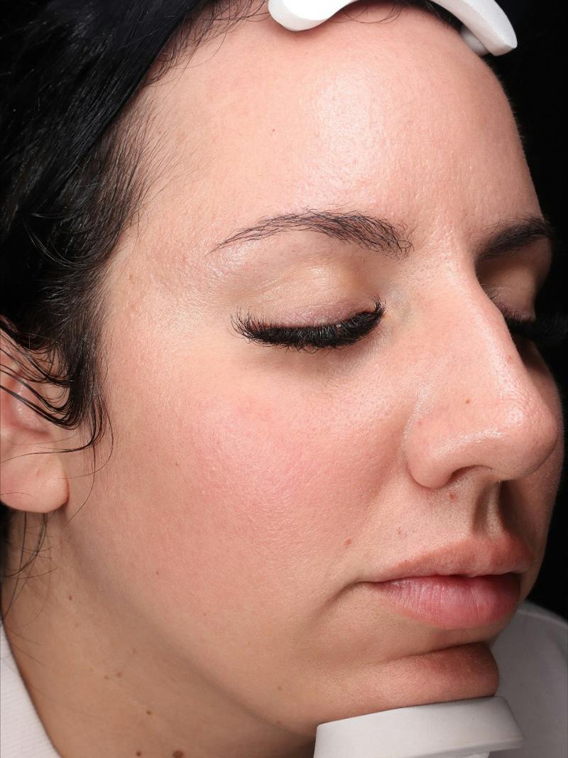 Skin Care Protocol Before & After Gallery - Patient 145945 - Image 4