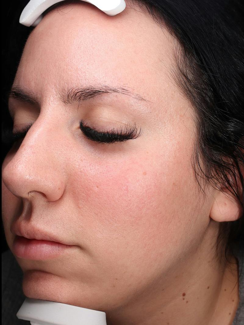 Skin Care Protocol Before & After Gallery - Patient 145945 - Image 5