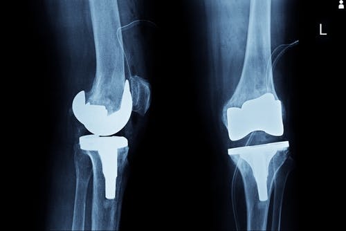 What is the Exactech Knee Device that has been Recalled?