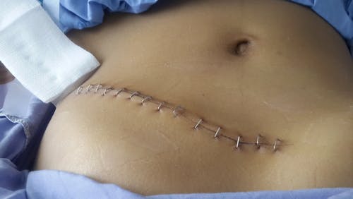 What Damage Can a Defective Medical Device Do to My Body?