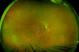 Why Should You Join the Elmiron Mass Tort Case