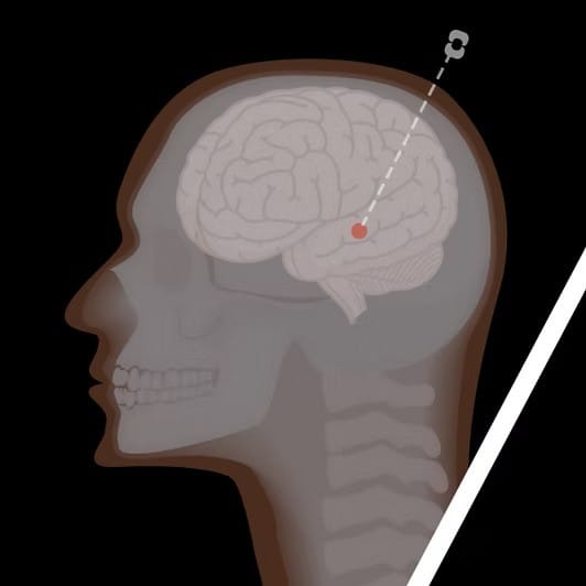 BIOPSY (Frame- or Frameless)