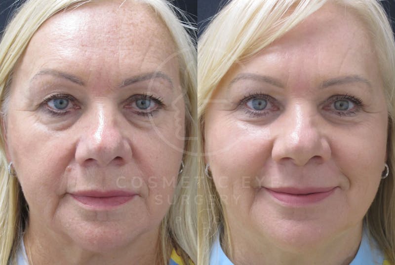Cosmetic Eye Gallery Before & After Gallery - Patient 426635 - Image 1