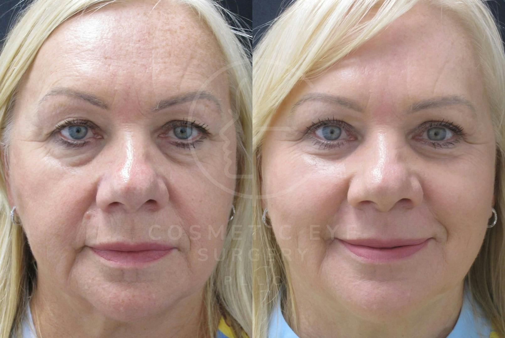 Full face CO₂ LASER resurfacing & Quad Eyelid Blepharoplasty Patient Image #1