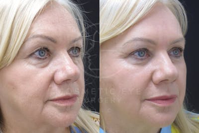 Cosmetic Eye Gallery Before & After Gallery - Patient 426635 - Image 2