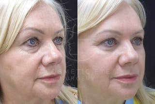 Cosmetic Eye Gallery Before & After Gallery - Patient 426635 - Image 2