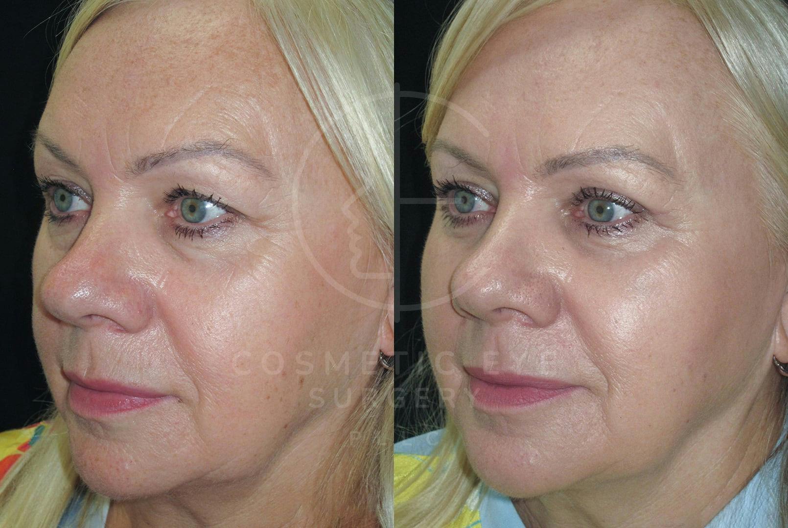 Full face CO₂ LASER resurfacing & Quad Eyelid Blepharoplasty Patient Image #3