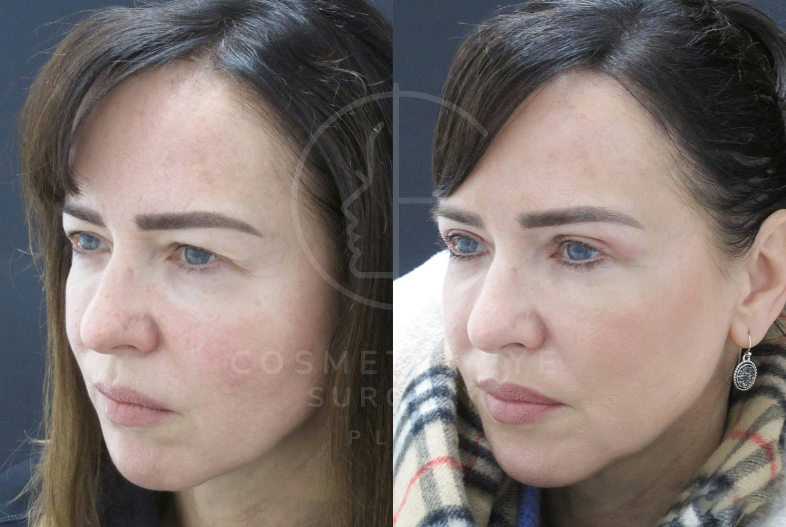 Upper Eyelid Blepharoplasty Patient Image #1