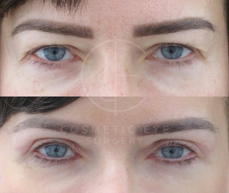 Cosmetic Eye Gallery Before & After Gallery - Patient 867341 - Image 2