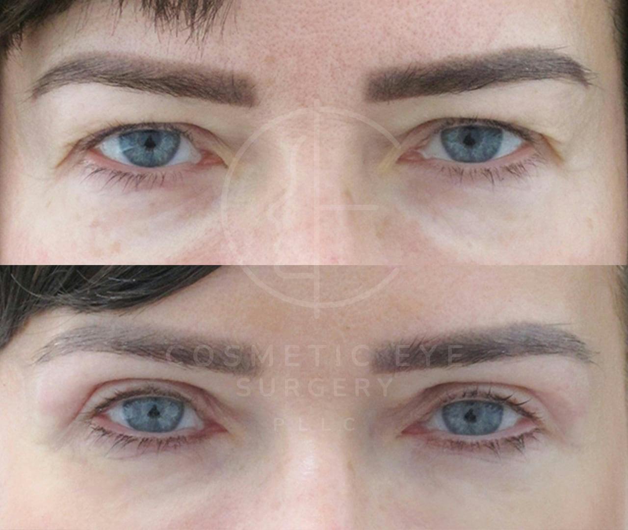 Upper Eyelid Blepharoplasty Patient Image #2