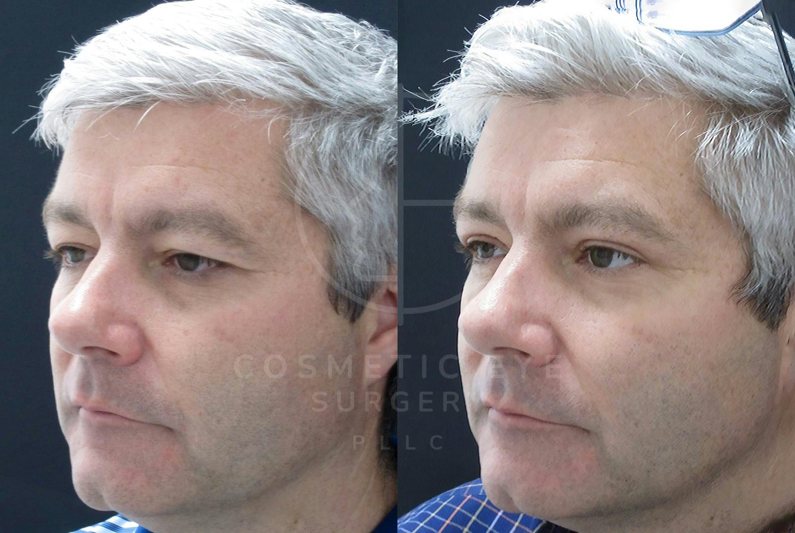 Upper Eyelid Blepharoplasty Patient Image #1