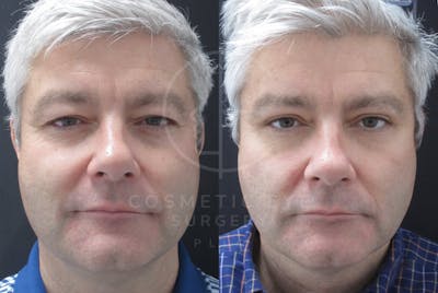 Cosmetic Eye Gallery Before & After Gallery - Patient 713721 - Image 2