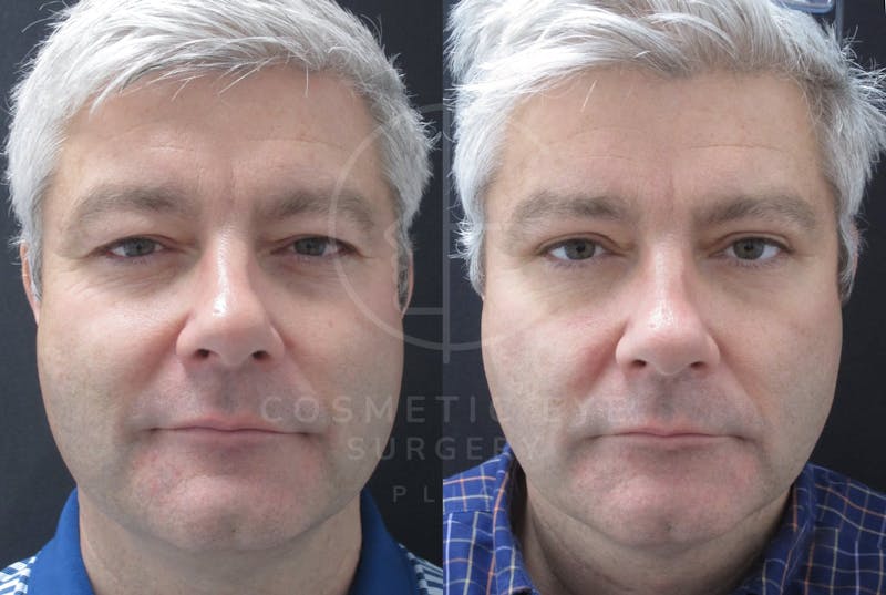 Cosmetic Eye Gallery Before & After Gallery - Patient 713721 - Image 2