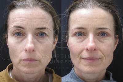 Cosmetic Eye Gallery Before & After Gallery - Patient 269404 - Image 1