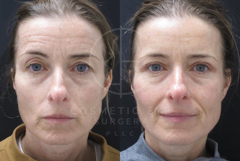 Cosmetic Eye Gallery Before & After Gallery - Patient 269404 - Image 1