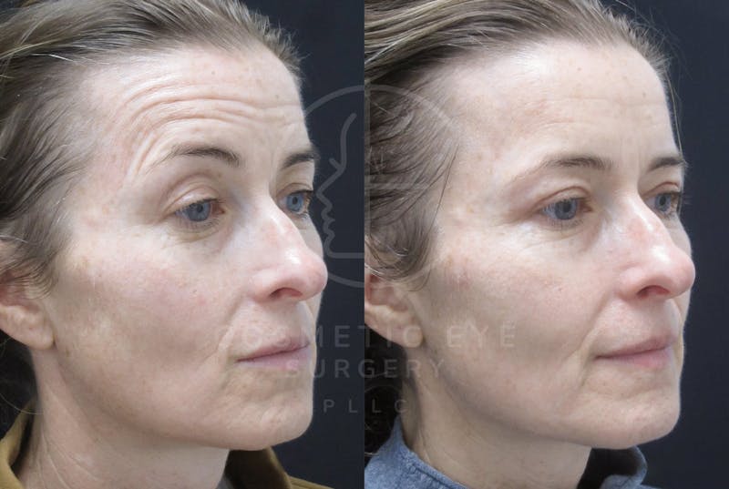 Cosmetic Eye Gallery Before & After Gallery - Patient 269404 - Image 2