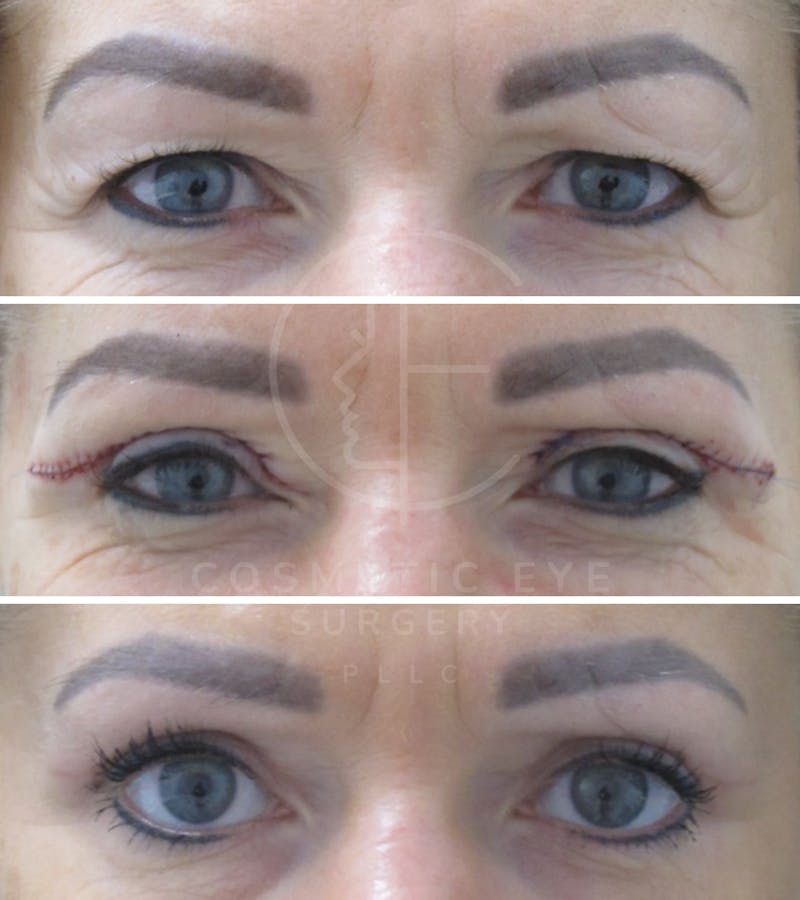 Cosmetic Eye Gallery Before & After Gallery - Patient 379334 - Image 3