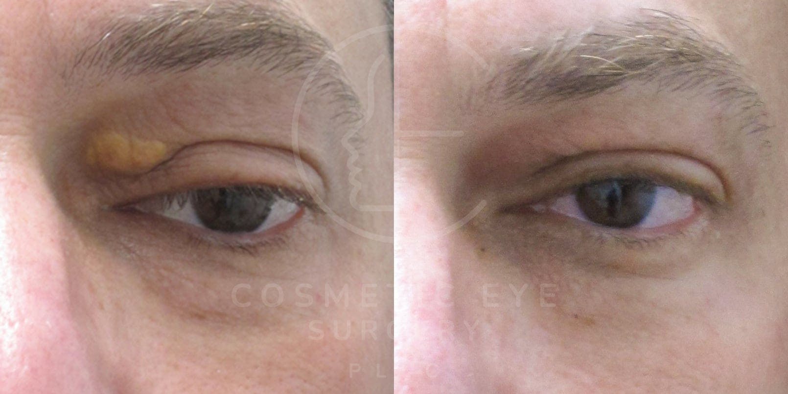 Xanthelasma Removal Patient Image #1