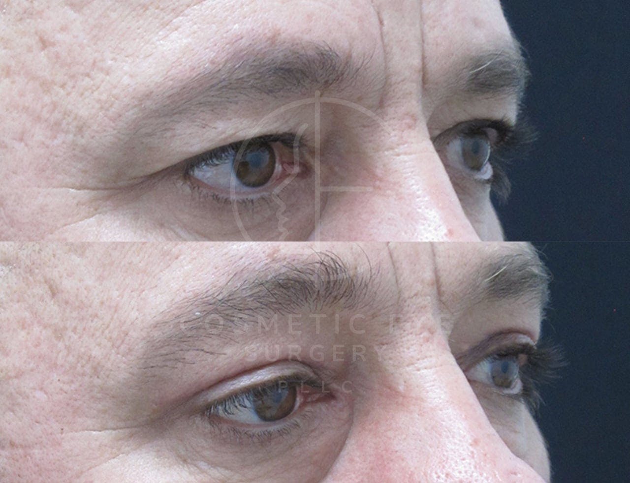Male Upper Eyelid Blepharoplasty Patient Image #1