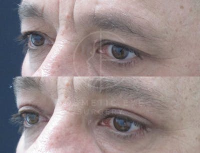 Cosmetic Eye Gallery Before & After Gallery - Patient 119637 - Image 2