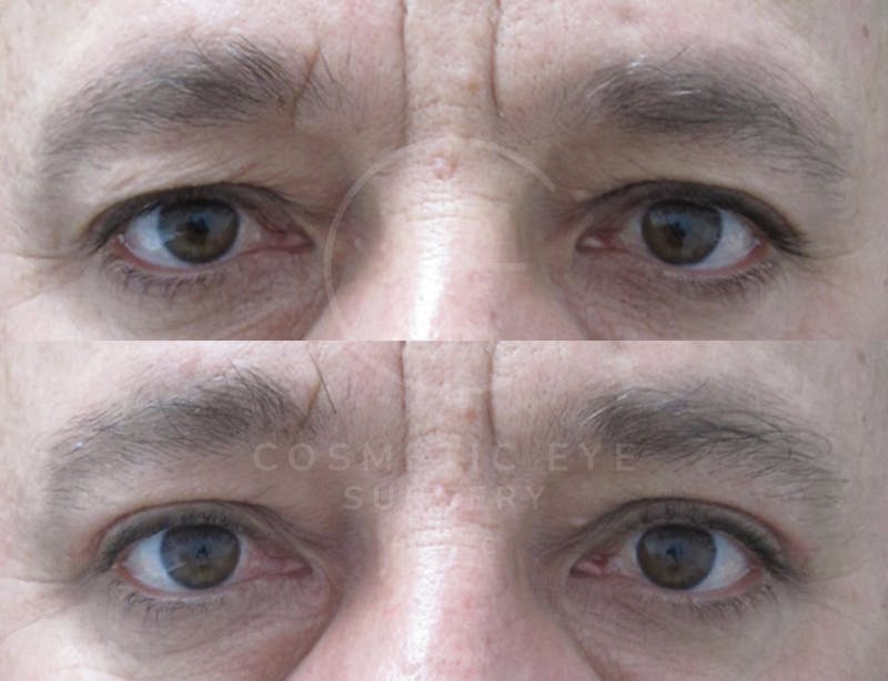 Cosmetic Eye Gallery Before & After Gallery - Patient 119637 - Image 3