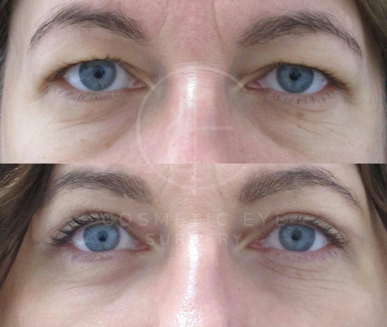 Combo Blepharoplasty & Lower Eyelid CO₂ resurfacing Patient Image #4