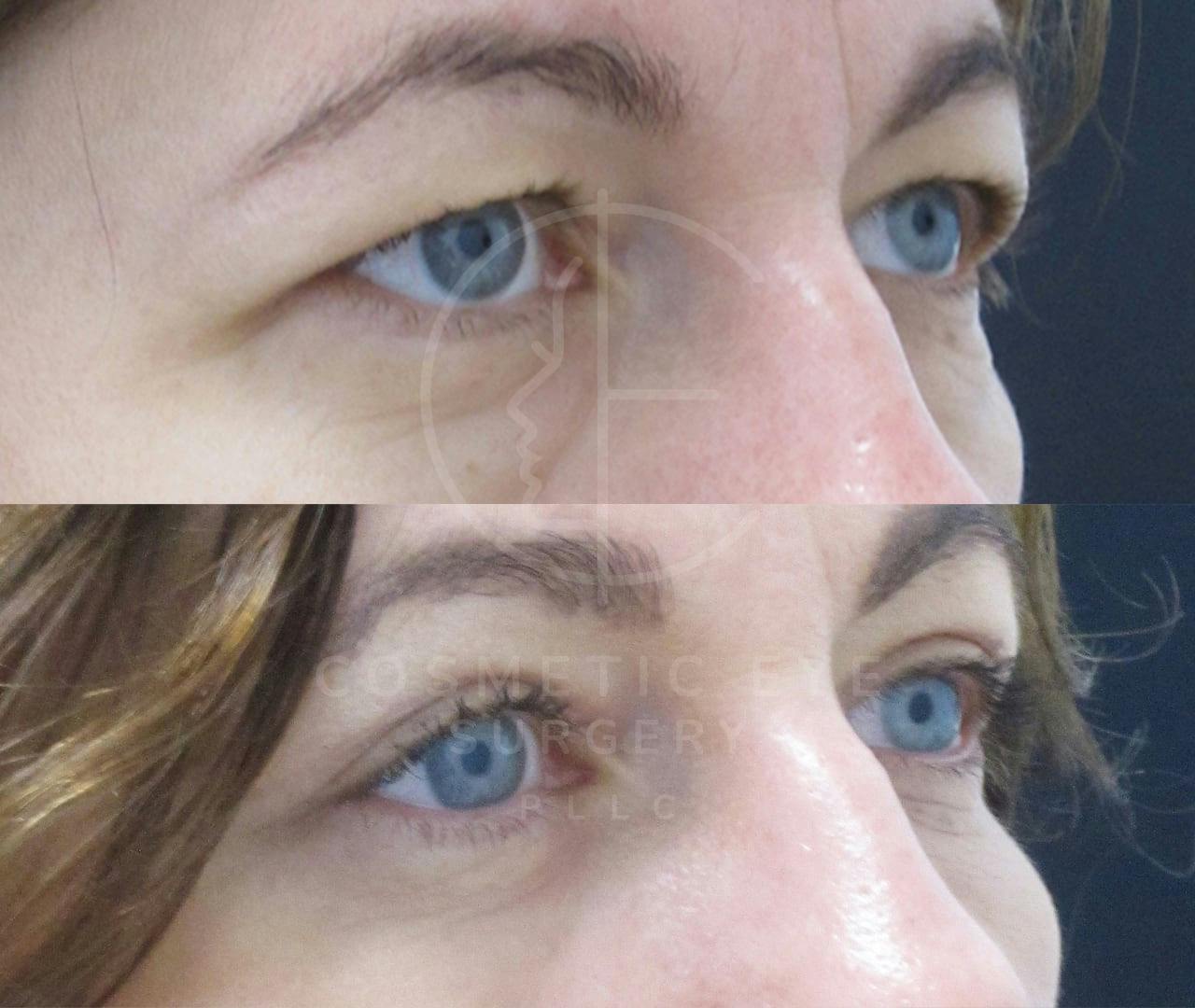 Combo Blepharoplasty & Lower Eyelid CO₂ resurfacing Patient Image #3