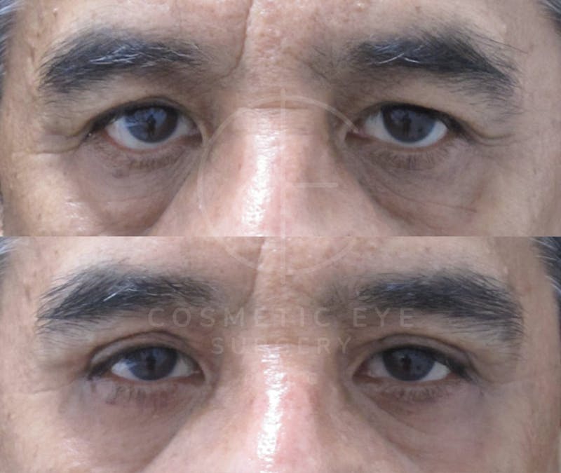 Cosmetic Eye Gallery Before & After Gallery - Patient 734825 - Image 1