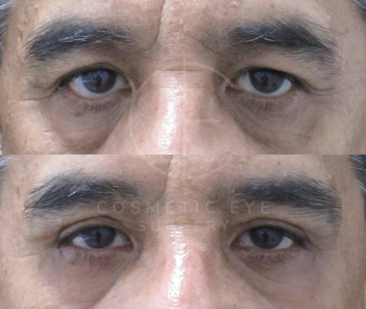 Lower Eyelid Ectropion Repair & Upper Eyelid Blepharoplasty Patient Image #1