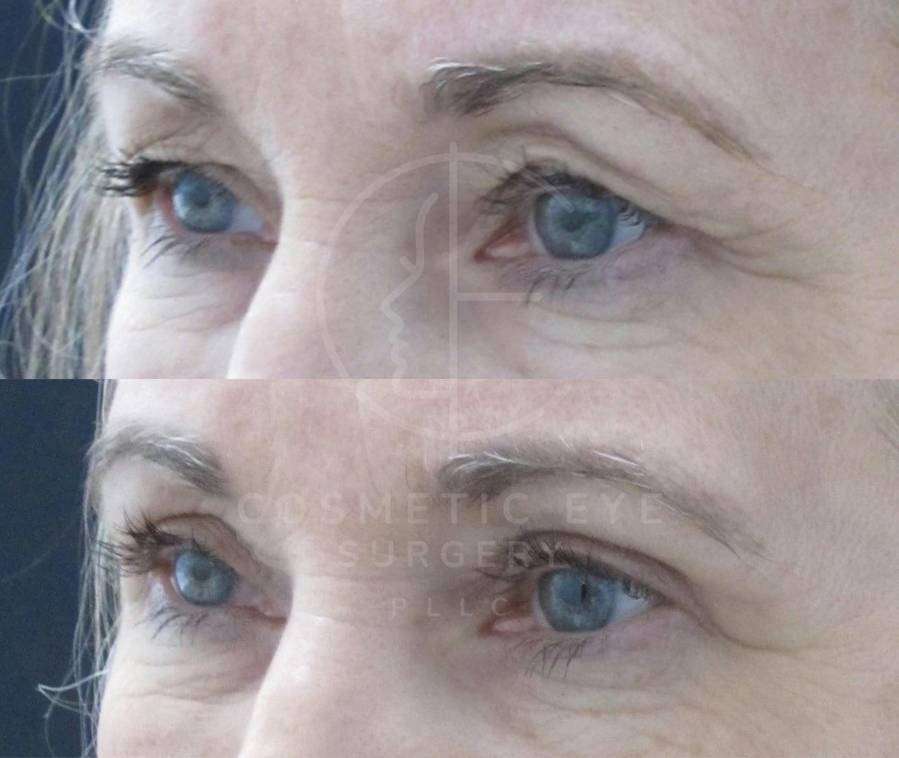 Upper Eyelid Blepharoplasty Patient Image #4