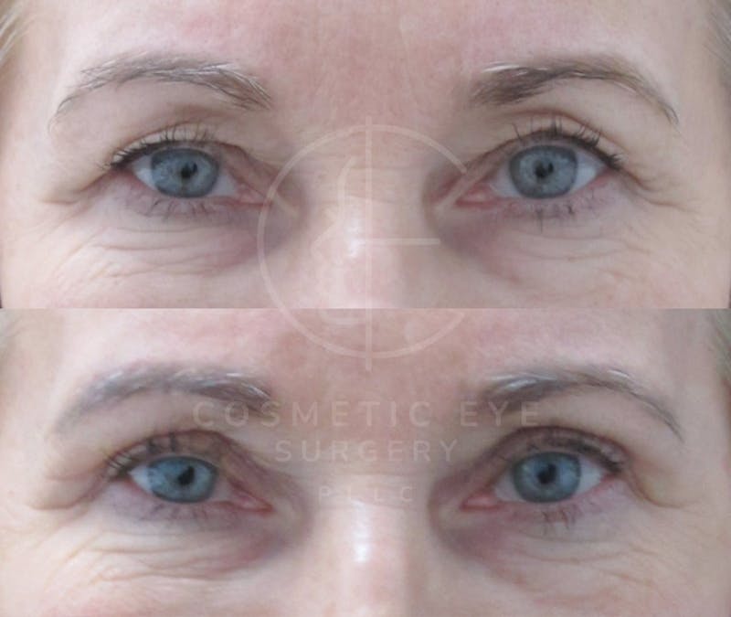 Cosmetic Eye Gallery Before & After Gallery - Patient 115846 - Image 3