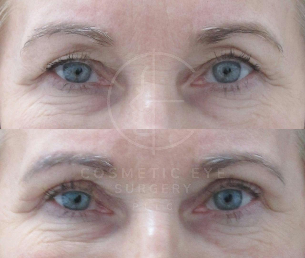 Upper Eyelid Blepharoplasty Patient Image #3
