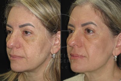 Cosmetic Eye Gallery Before & After Gallery - Patient 711494 - Image 1