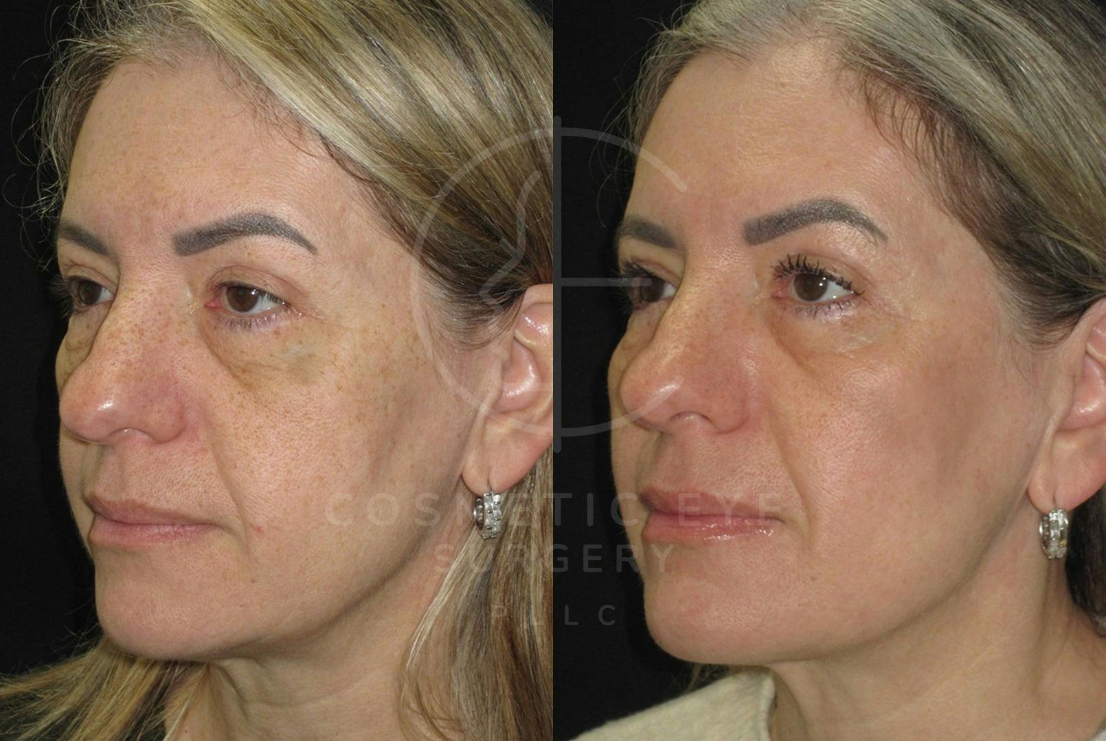 Full Face CO₂ LASER Treatment Patient Image #1