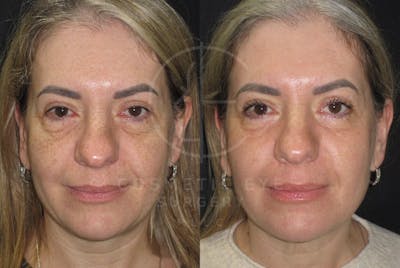 Cosmetic Eye Gallery Before & After Gallery - Patient 711494 - Image 2