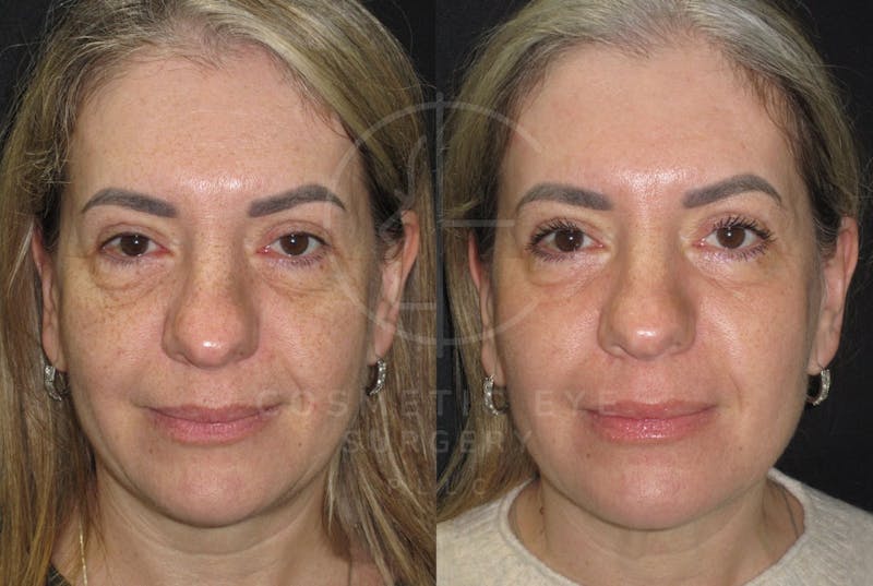 Cosmetic Eye Gallery Before & After Gallery - Patient 711494 - Image 2