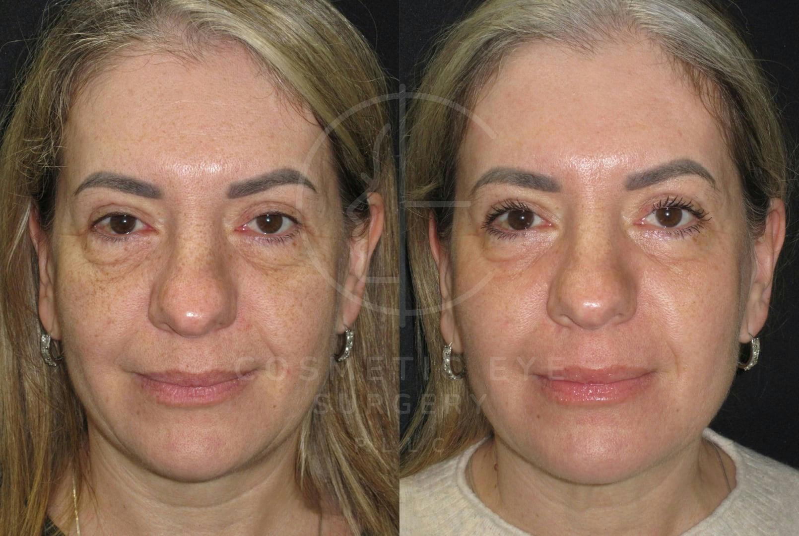 Full Face CO₂ LASER Treatment Patient Image #2