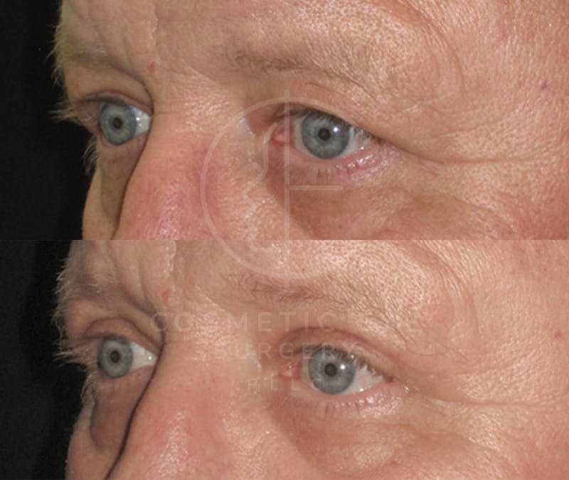 Cosmetic Eye Gallery Before & After Gallery - Patient 250647 - Image 4
