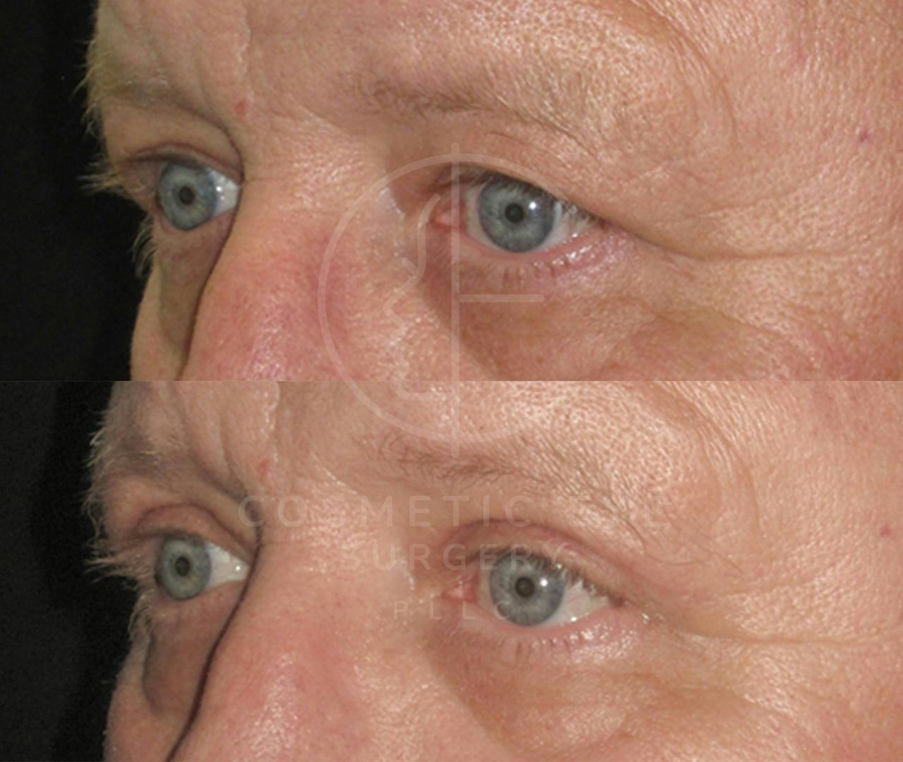 Male Upper Eyelid Surgery Patient Image #4