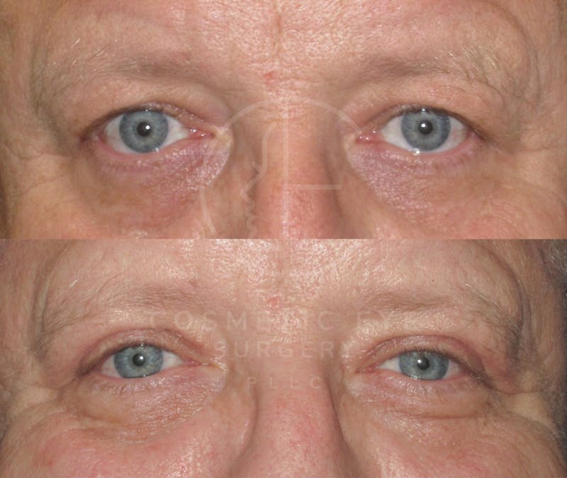Cosmetic Eye Gallery Before & After Gallery - Patient 250647 - Image 3