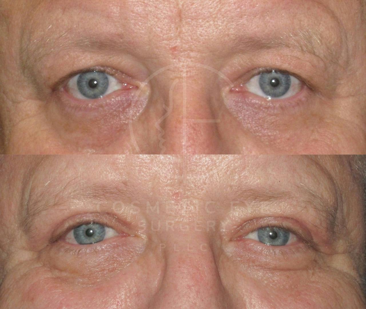 Male Upper Eyelid Surgery Patient Image #3