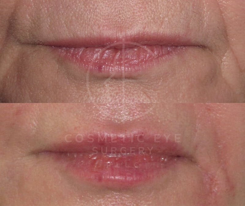 Cosmetic Eye Gallery Before & After Gallery - Patient 283499 - Image 1