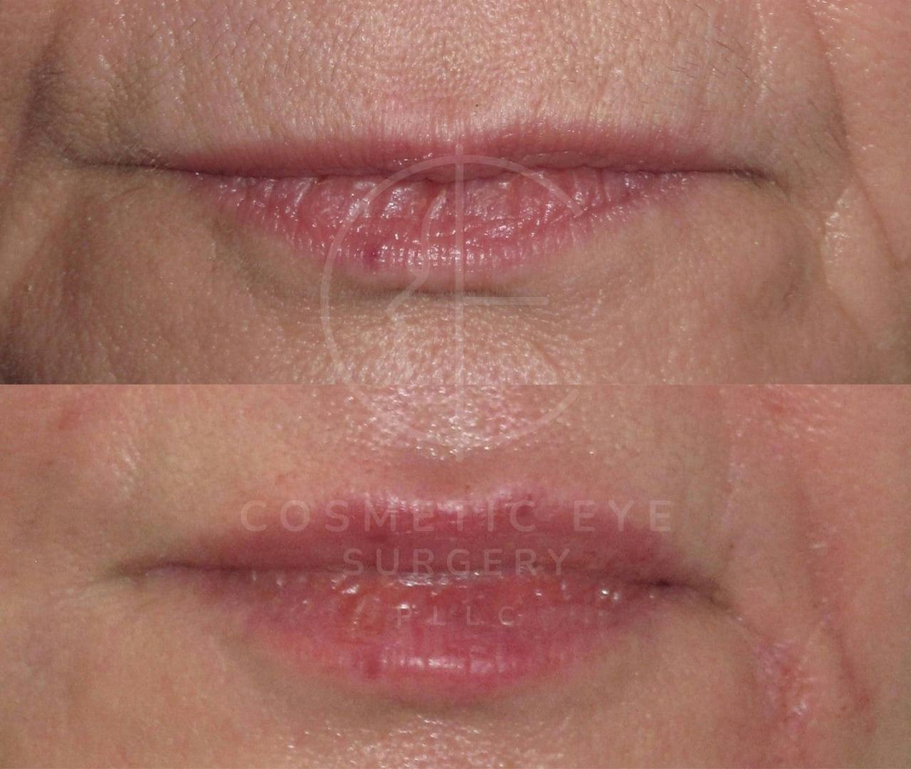Filler Injection to Lips Patient Image #1