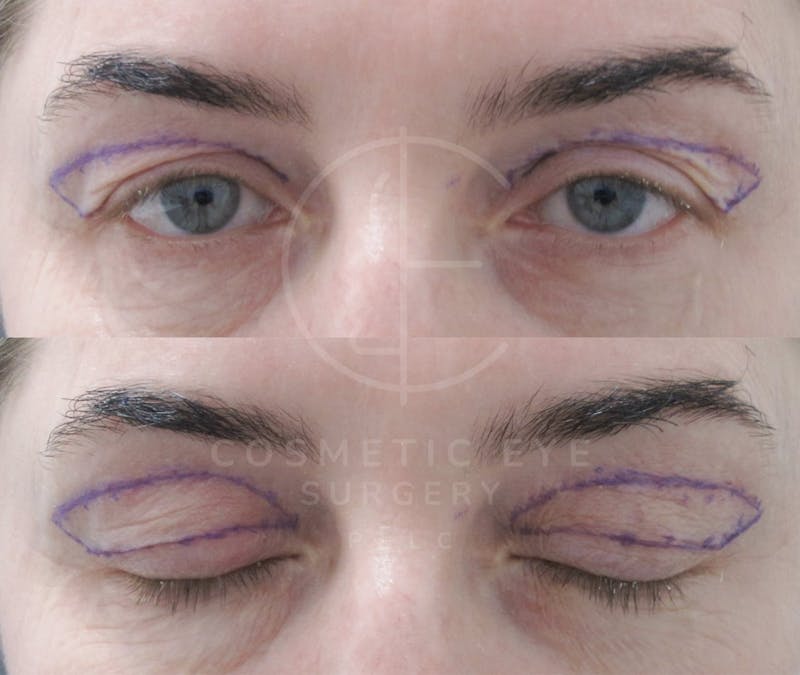 Cosmetic Eye Gallery Before & After Gallery - Patient 118542 - Image 4