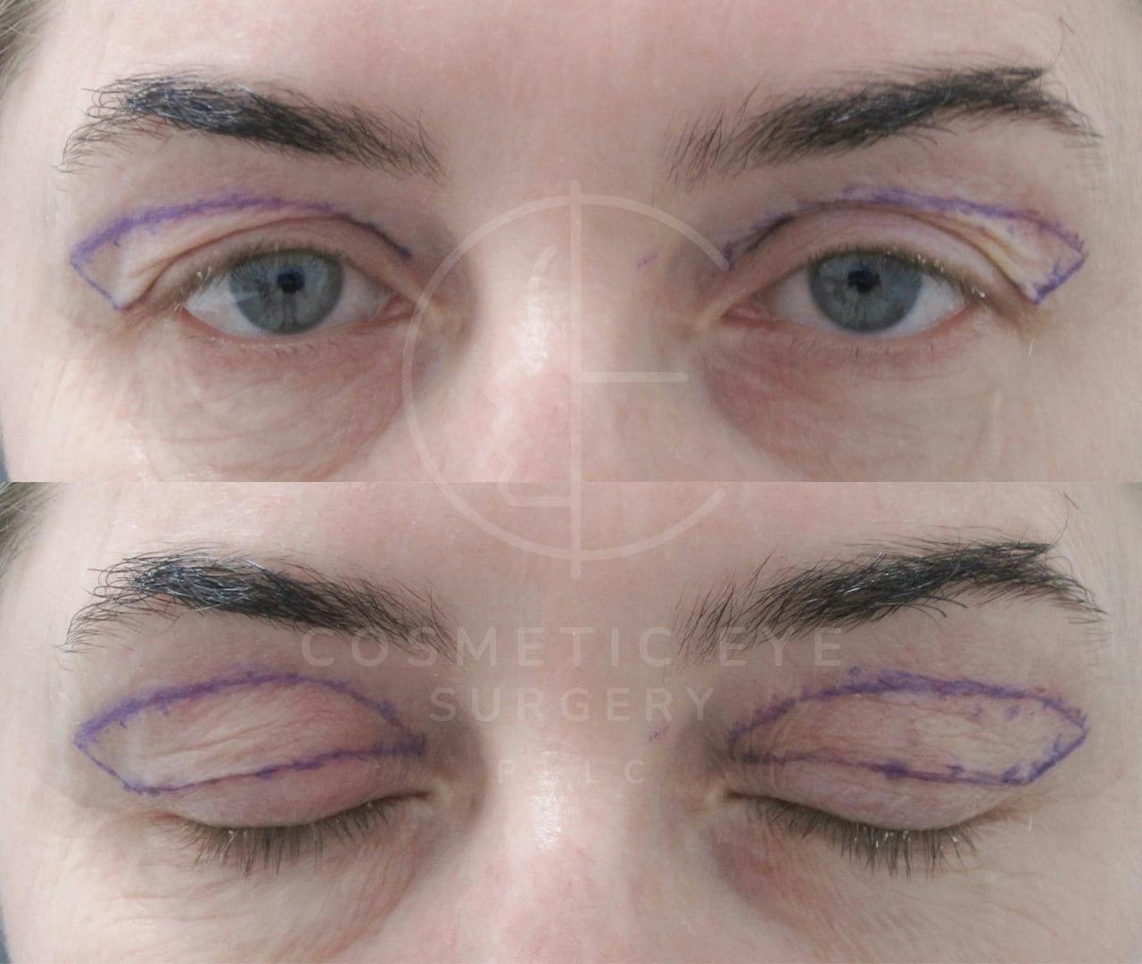 Upper Eyelid Blepharoplasty Patient Image #4