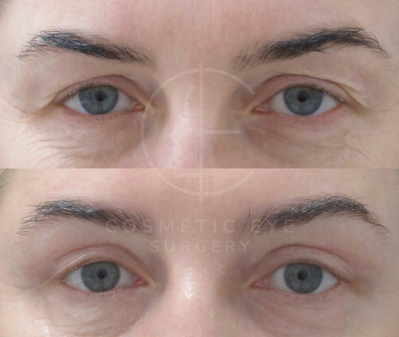 Upper Eyelid Blepharoplasty Patient Image #3