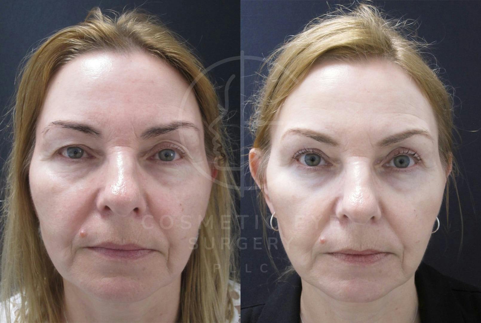 Upper Blepharoplasty for Eyelid Asymmetry. Patient Image #3