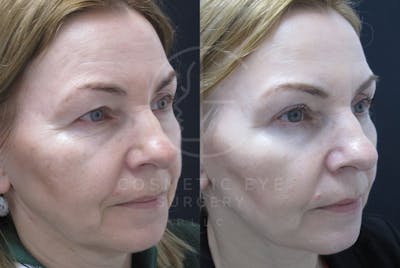 Cosmetic Eye Gallery Before & After Gallery - Patient 130394 - Image 2